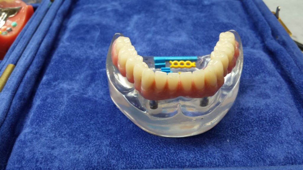 protezy na miniimplantach 2