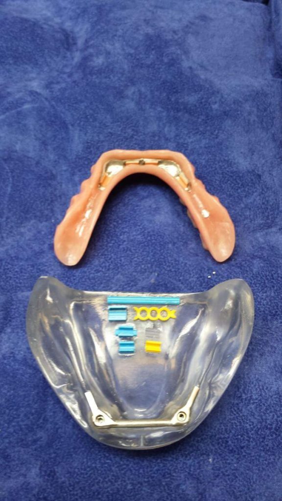 protezy na miniimplantach 3
